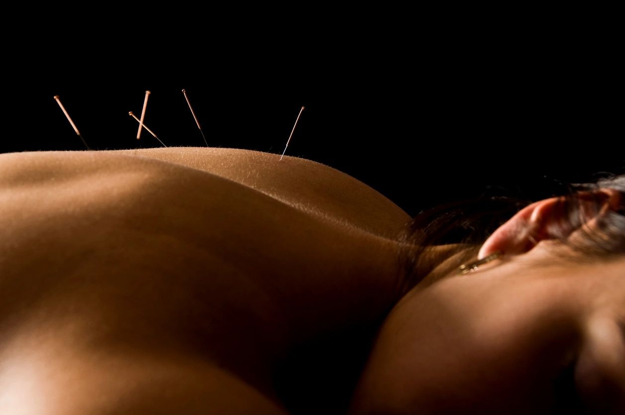 Acupuncture treatment close-up